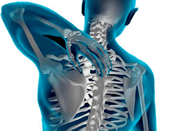 Manifestazioni dell'osteocondosi della colonna vertebrale toracica