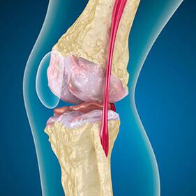 La tensione eccessiva del muscolo della coscia provoca il dolore al ginocchio